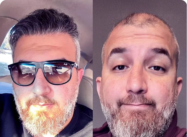 قبل وبعد زراعة الشعر — مثال 1
