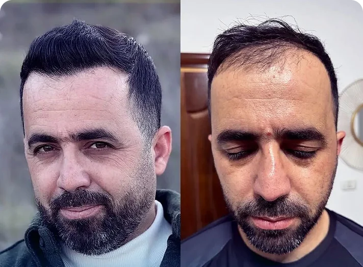 قبل وبعد زراعة الشعر — مثال 2