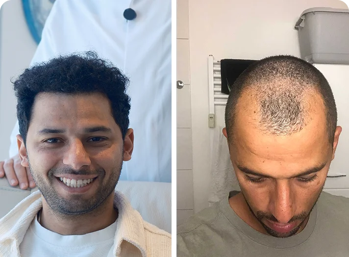 قبل وبعد زراعة الشعر — مثال 3