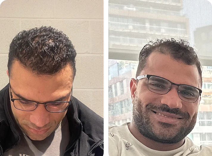 قبل وبعد زراعة الشعر — مثال 5