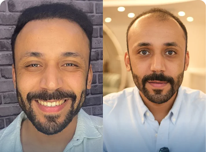 قبل وبعد زراعة الشعر — مثال 6