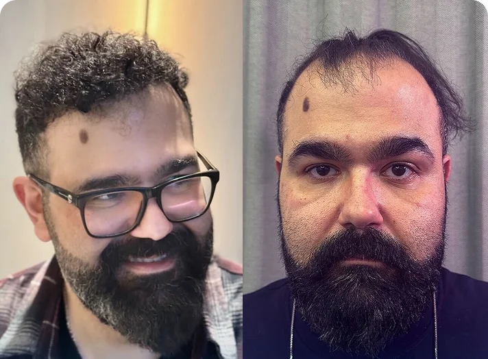 قبل وبعد زراعة الشعر — مثال 7